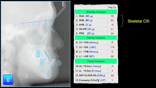 Chris Chang Ortho.Extraction of the lower 2nd molars to solve severe CIII malocclusion. Ортодонтия