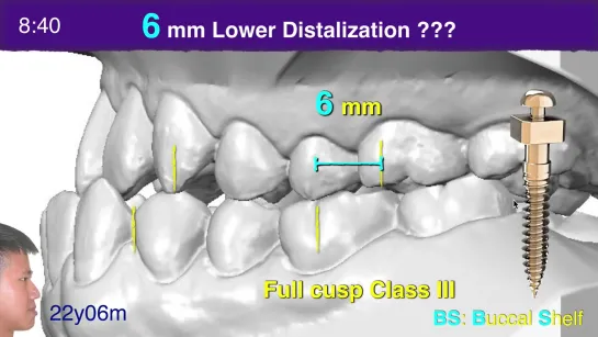 Chris Chang  Screws for fixed appliances and aligners 2020 AAO Part I