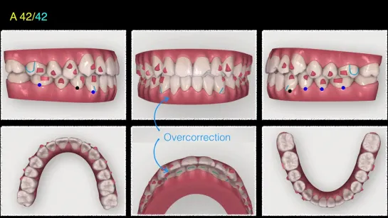 Chris Chang. Aligner treatment of Class III malocclusion with anterior crossbite