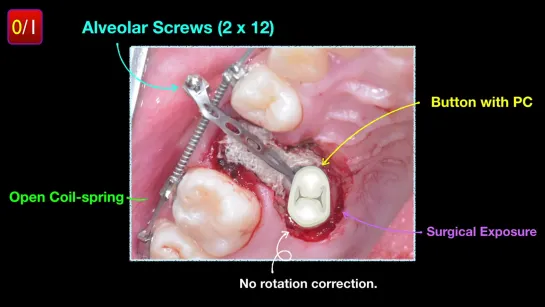 Simple Solution for Impacted Maxillary 2nd Premolar with OBS