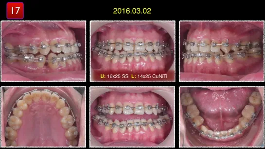 Open Bite Correction - 2020 AAO Winter Chris Chang - 2. Ортодонтия