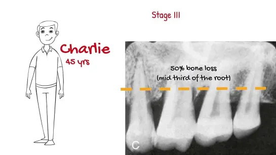 The new periodontal classification