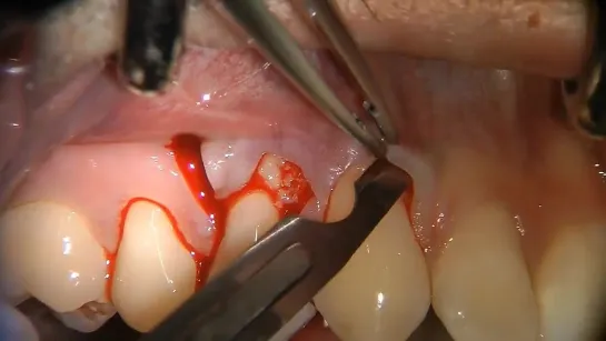 Dr Tirone Federico. Coronally advanced flap and connective tissue graft.