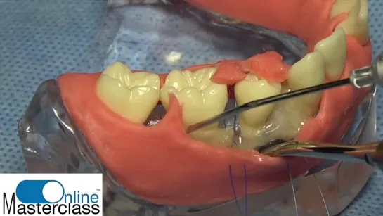 Step by step Periodontal Regenerative Surgery with Straumann Emdogain and Papilla preservation.