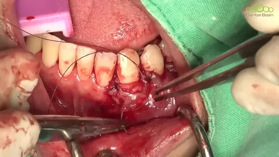 CT graft for root coverage ( Miller class III )- [Dr. Kim Jaeyoon]