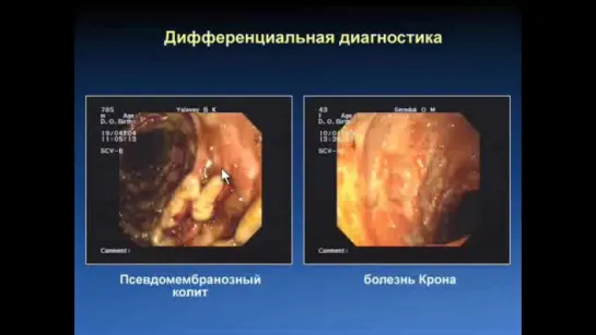 Воспалительные заболевания кишечника, ВЗК, диагностика ВЗК, эндоскопия ВЗК © bowel disease