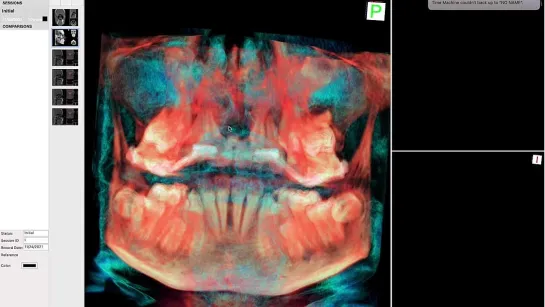 Hyrax skeletal expansion. What happens inside the bone.