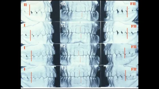 Occlusion plane - Introduction and measurements. Японский ролик.