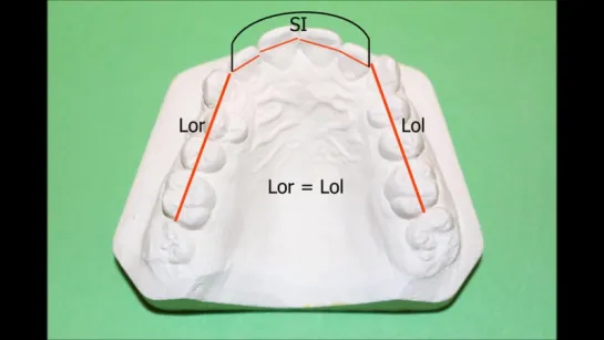 Orthodontic model analysis in Permanent Dentition. Ортодонтия.