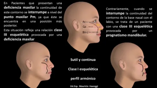 Análisis de tejidos blandos y curva de Arnett.Ортодонтия.