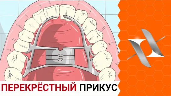 ПЕРЕКРЁСТНЫЙ прикус | Причины. Последствия. Лечение. (Брекеты, стоматология)