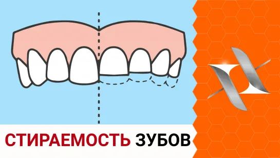 СТИРАЕМОСТЬ ЗУБОВ | Причины. Последствия. Лечение. (Брекеты, стоматология)