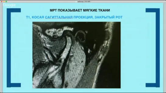 Диагностика функциональных нарушений ВНЧС при помощи вибрационного анализа. Гнатология. Светлана Коваль.