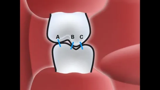 Контакты зубов (типы А, В, С)