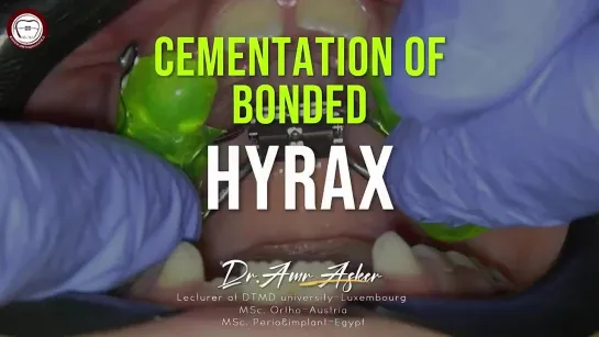 Bonded HYRAX try-in-cementation with 2 arms for face mask , maxilla expansion in mixed dentition