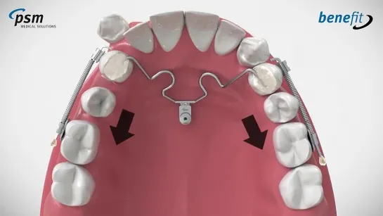 PSM - BENEfit Arnoudizer. Ортодонтия.