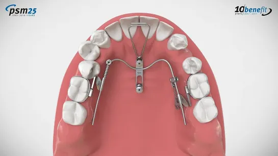 PSM T-Mesial Distalslider. Установка аппарата. Ортодонтия.