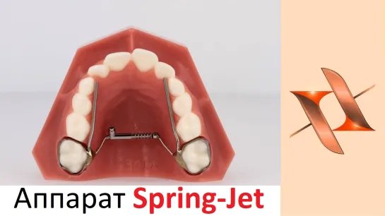 Ортодонтический несъёмный аппарат для расширения Spring Jet.