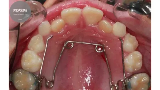 Morphing - Orthodontic maxillary expansion with Quad Helix