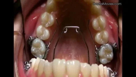 Insertion of the Wilson 3D Quad-Helix Appliance. Ортодонтия.