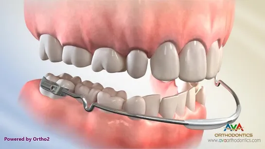 Orthodontic Space Management - Lip Bumper Appliance. Губной бампер.