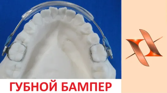 Губной бампер - Lip bumper. Ортодонтический аппарат.