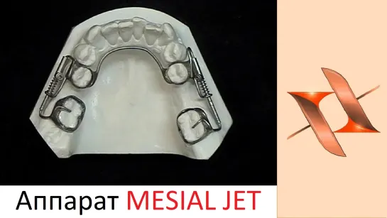 Аппарат Мезиал Джет (Mesial Jet).Ортодонтия.