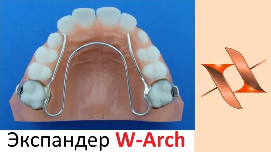 Экспандер W - Arch. Ортодонтический аппарат.