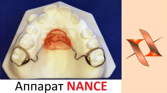 Аппарат (кнопка) Nance.Ортодонтия.