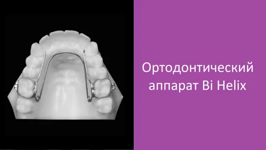 Популярно: Orthodontic Expander or Spacer - Lower BiHelix Appliance