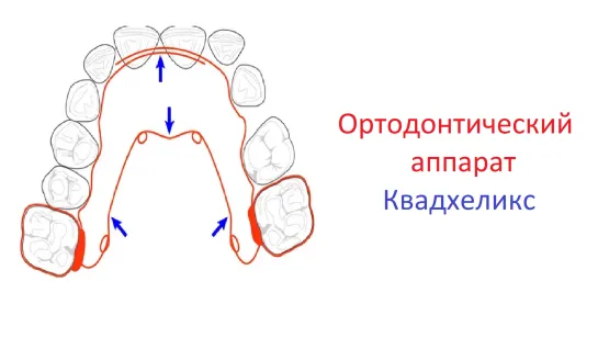 Ортодонтический аппарат Квадхеликс (Quad Helix).Принцип действия, активация.