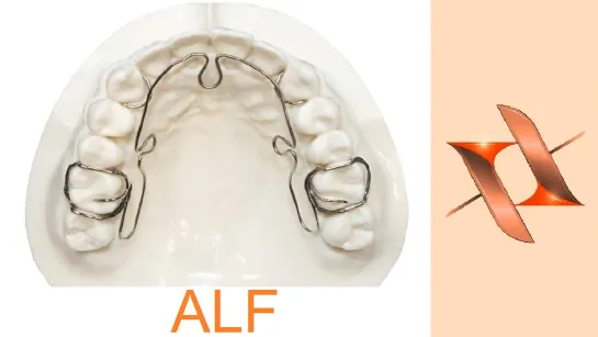 Ортодонтический аппарат "лёгких сил"ALF. Фиксация, активация, механика.Стоматология.