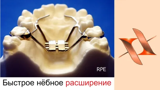 Ортодонтические аппараты Hyrax (RPE) для быстрого нёбного расширения. Стоматология.