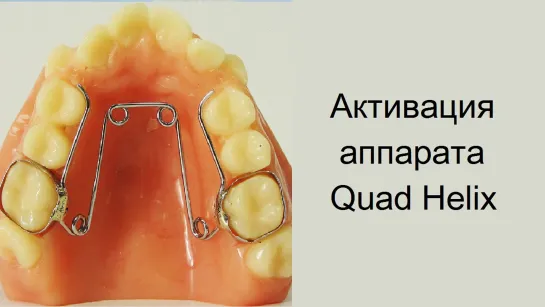 Quad Helix  - активация аппарата. Ортодонтия.