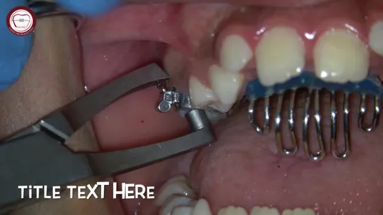 tongue guard removal using band removing plier, Orthodontics-pedodontics. Ортодонтия