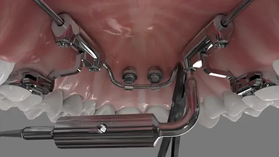 Сompliance-free treatment (advanced molar distalization appliance)