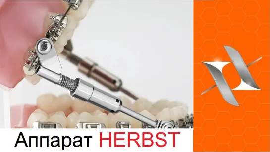 Herbst appliance. Аппарат Гербста. Ортодонтия.