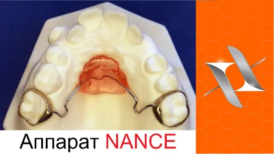 Ортодонтический аппарат Nance.Nance Appliance.