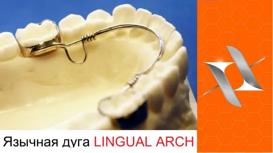 Ортодонтические аппараты. Язычная дуга. Lingual Arch.