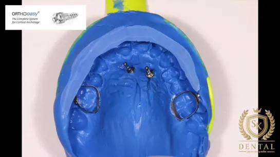 TAD anchored palatal expansion appliance by Dr.Svitlana Koval, MSc. Ортодонтия.