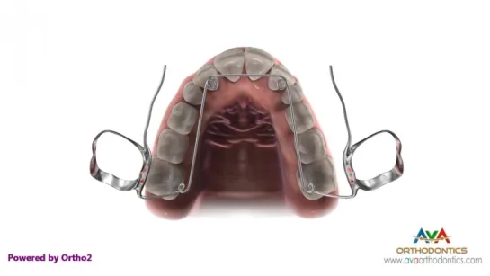 Expander - Quad Helix Type - Orthodontic Device. Пропедевтика ортодонтии.