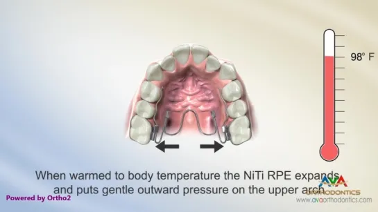 Expander - NiTi Type - Orthodontic Device. Пропедевтика ортодонтии.