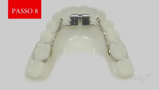 Barra Expander Mandibular Расширитель нижней челюсти - 8 лабораторных шагов.Ортодонтия.