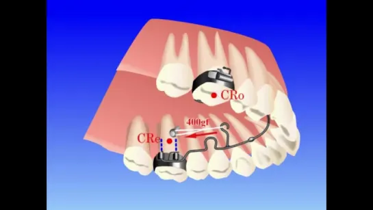 Lingual Distalizer 10.Ортодонтия.