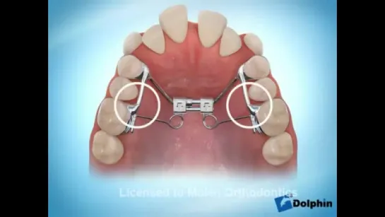 Аппараты для нёбного расширения Пендюлюм и Хайракс. Ортодонтия.