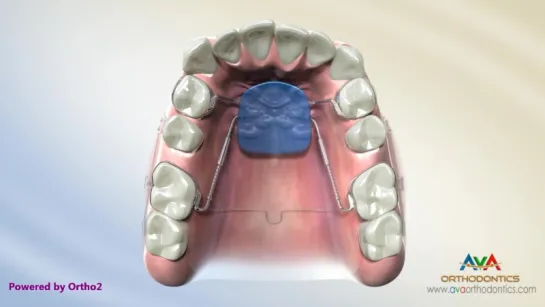 Distal Jet - Orthodontic Device. Ортодонтия.