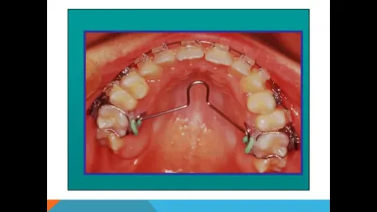 Quad-Helix and Open bite- Orthodontist.Квадхеликс. Ортодонтия.