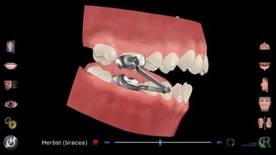 Orthodontics with a Herbst Appliance. Ортодонтия.