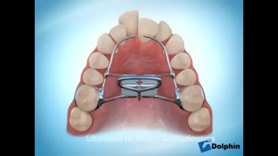 Palatal Expander. Ортодонтия.