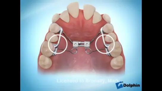 Fixed Pendulum Appliance with Expander (FPAE). Ортодонтия.